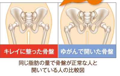 骨格が正常な人とゆがんで開いている人の比較図